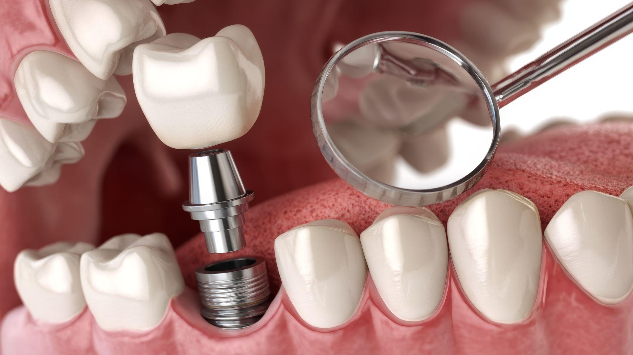 インプラントのメンテナンスはなぜ必要？方法・費用・頻度まで徹底解説